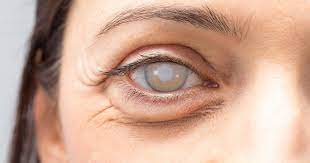 Người ngoài 60 tuổi cần chăm sóc mắt như thế nào? - 1