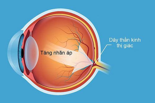 Người ngoài 60 tuổi cần chăm sóc mắt như thế nào? - 2