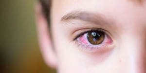 Đau mắt đỏ là gì, nguyên nhân gây đau mắt đỏ và cách điều trị