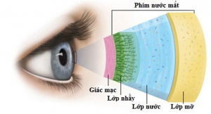 Hội chứng khô mắt và cách điều trị